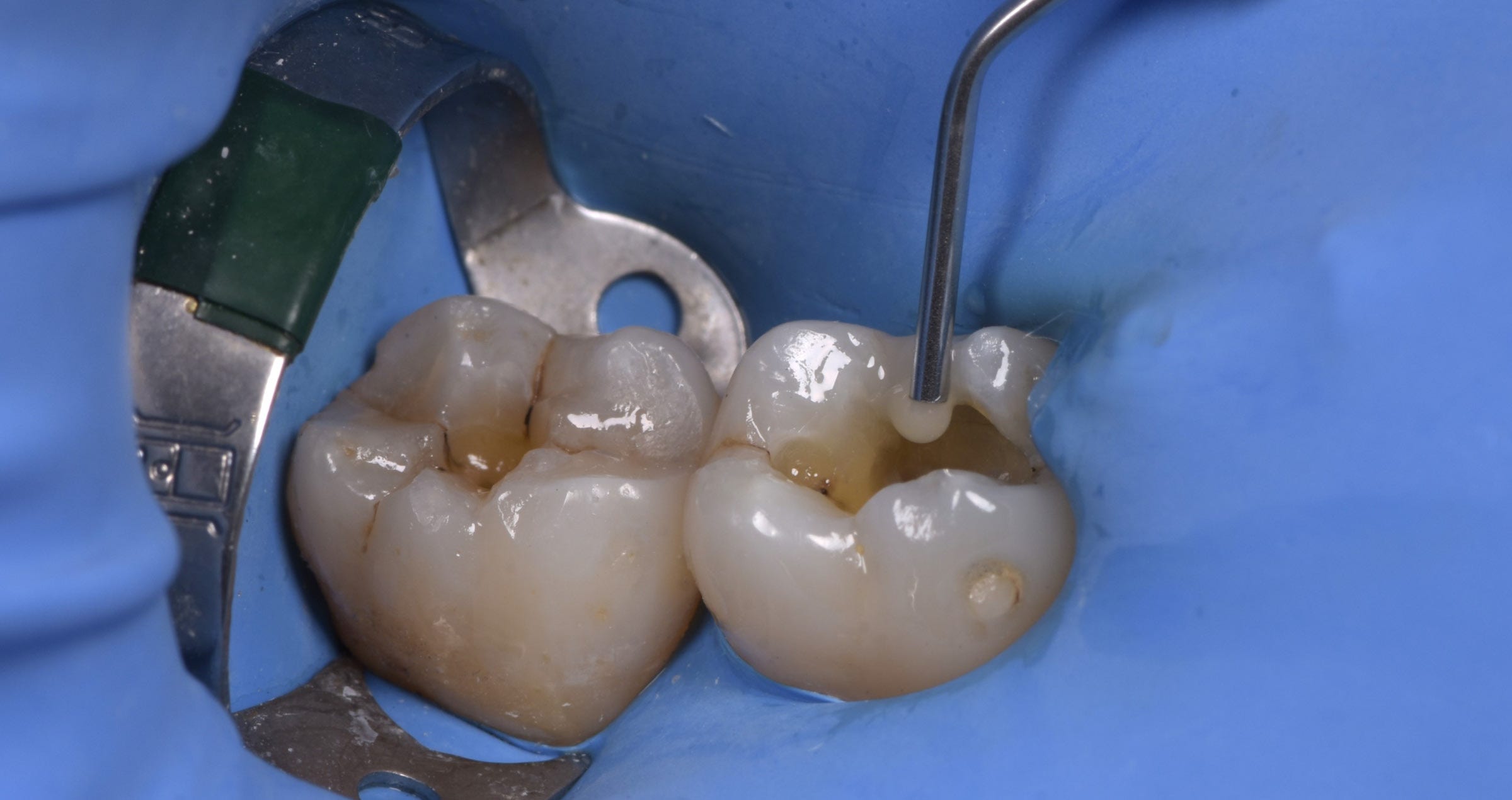 Amalgam replacement with flowable composite