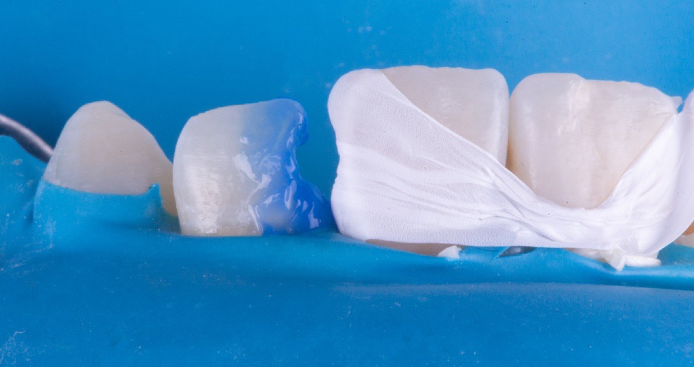 Rebuilding a natural smile