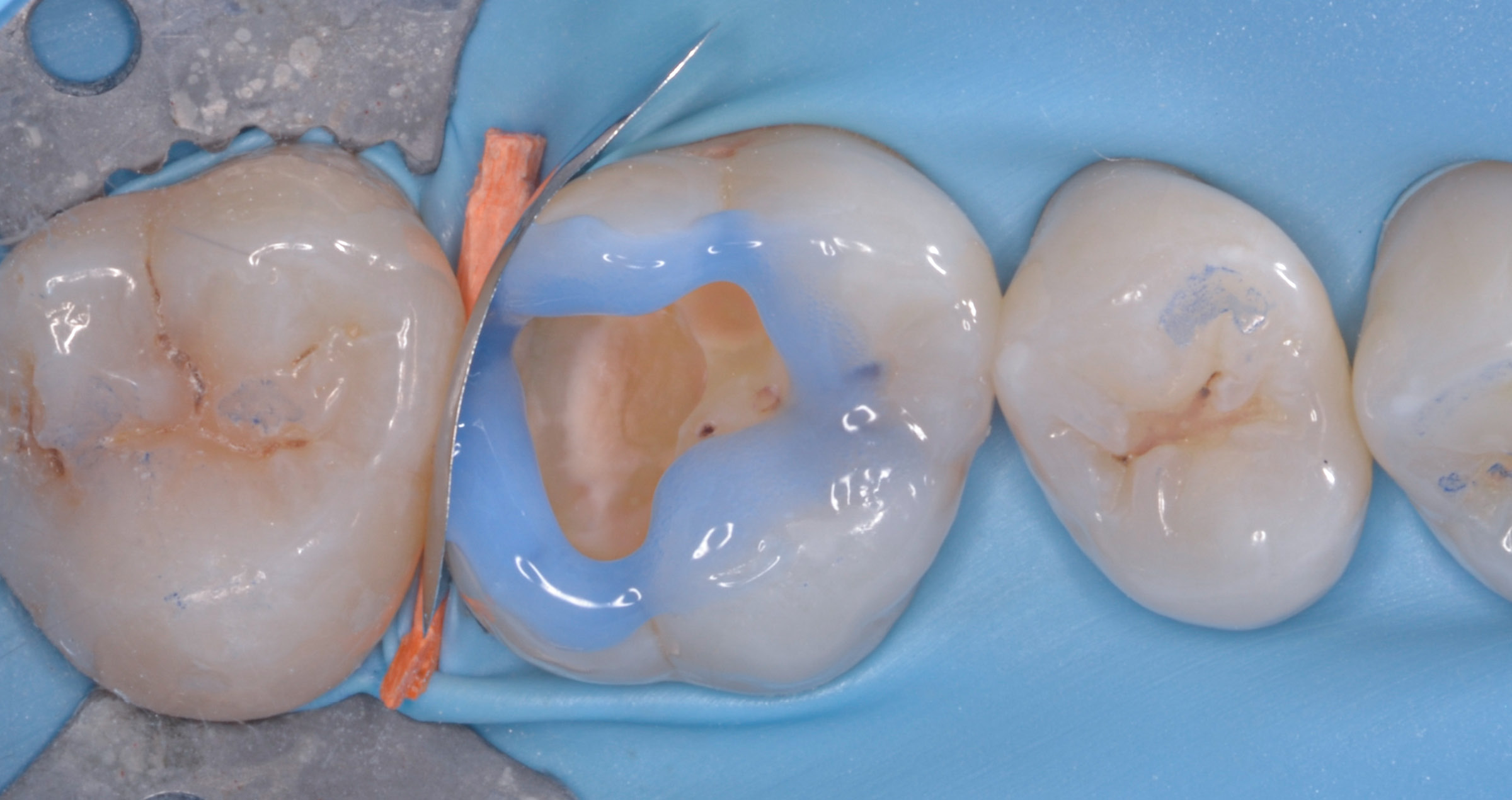 Functional and aesthetic posterior restoration procedure