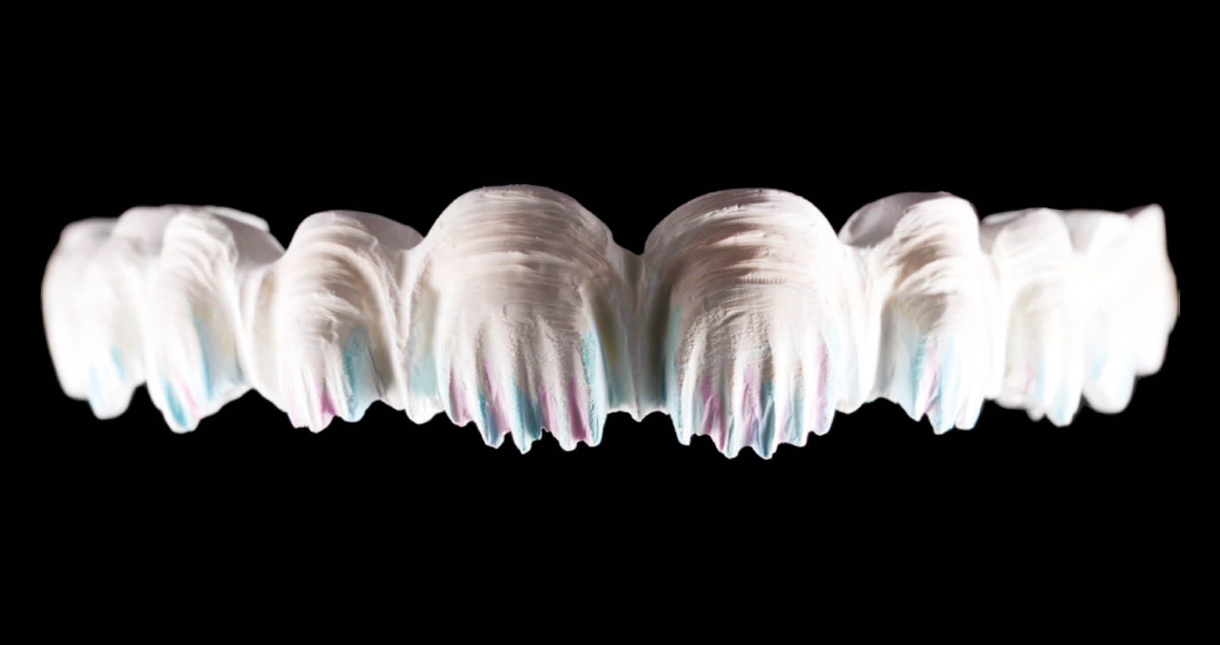 Complex implant-supported maxillary reconstruction