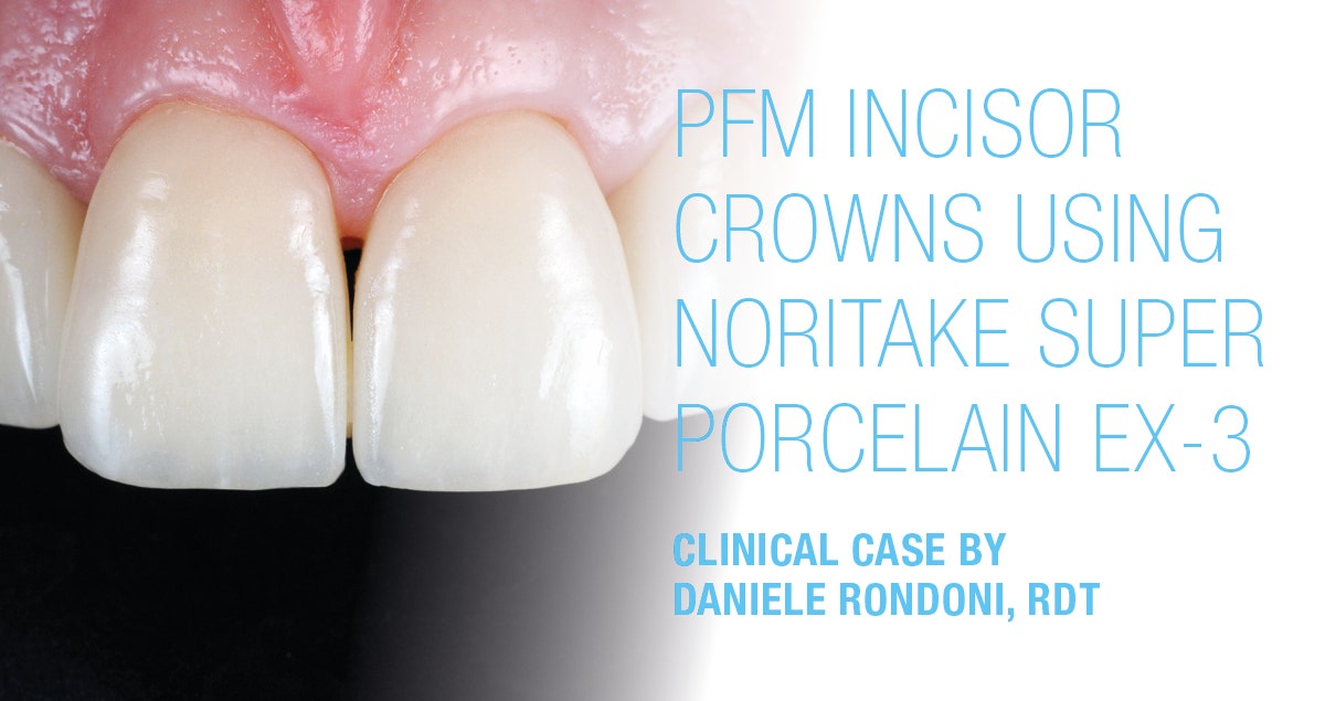 Clinical case - PFM incisor crowns using Noritake Super Porcelain EX-3