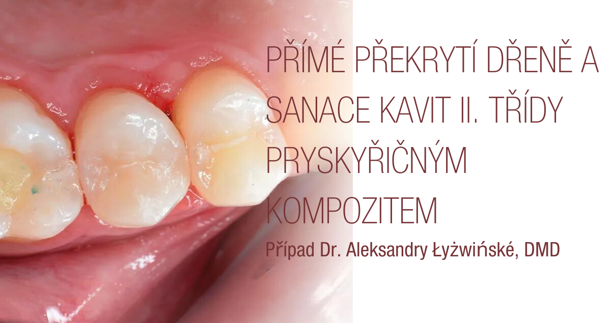 Přímé překrytí dřeně a sanace kavit II. třídy pryskyřičným kompozitem