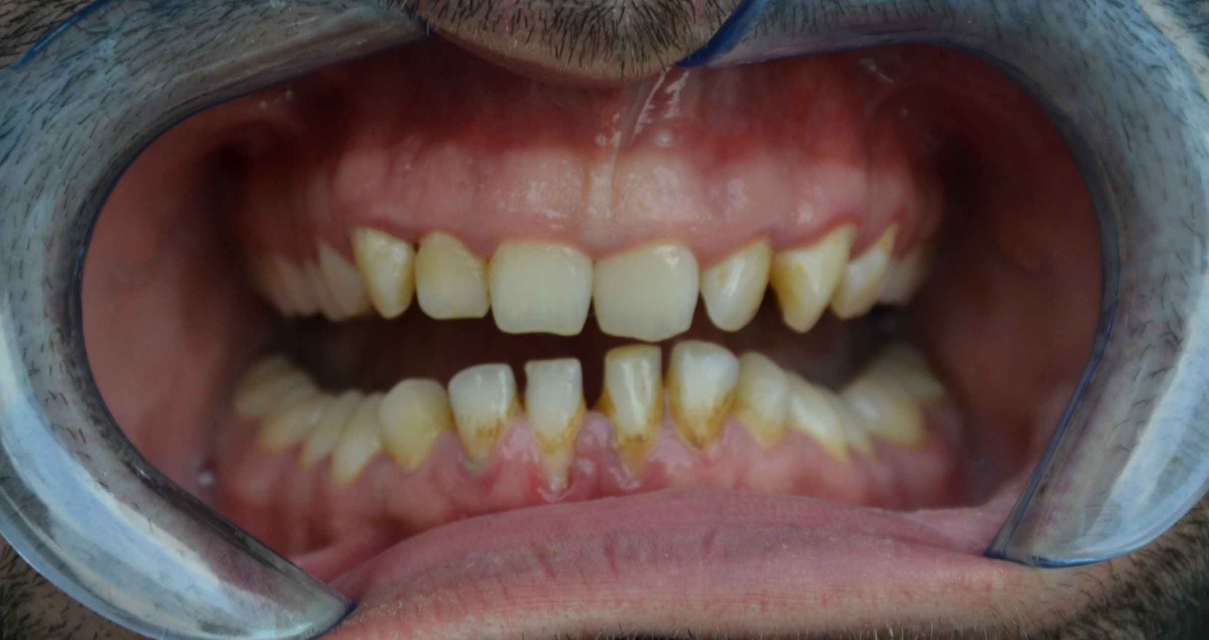 Universal Light: For natural results in brighter teeth