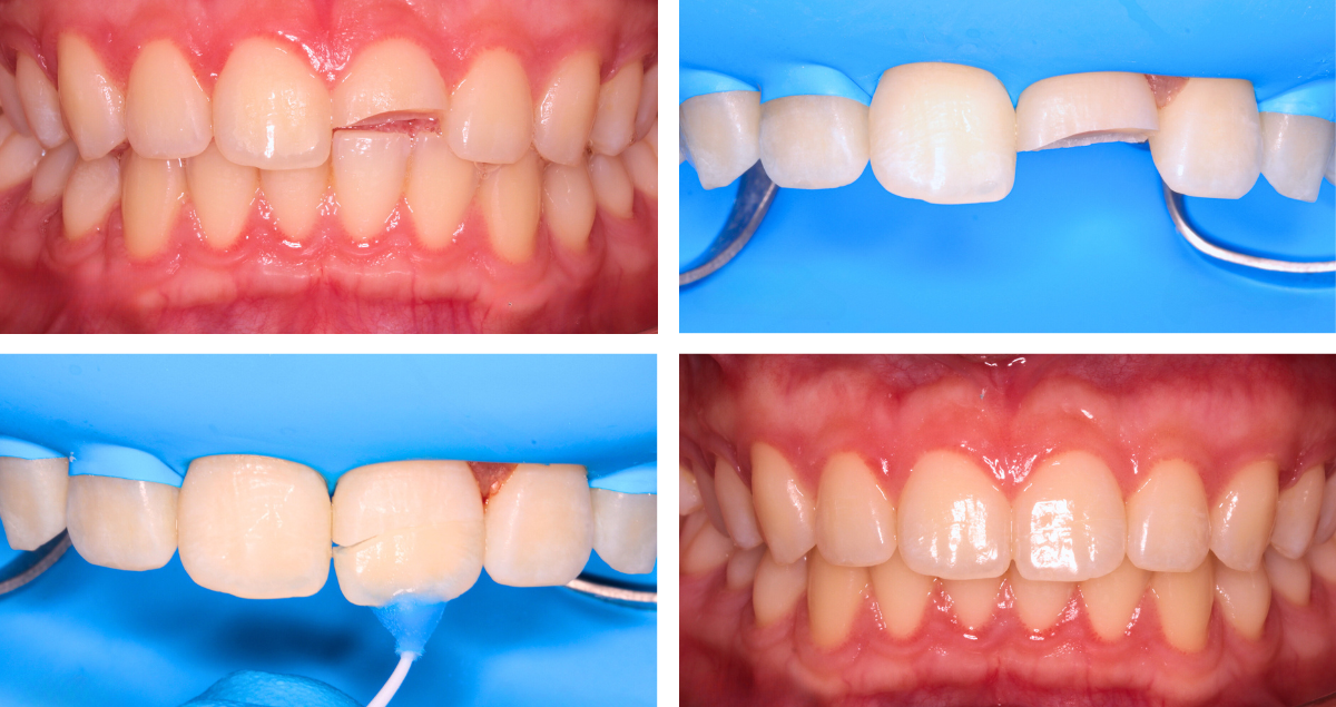Trauma case: Cementation of a fractured crown fragment