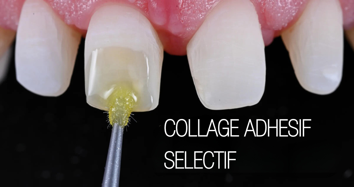 Colle résine universelle : avez-vous déjà essayé un 3ème mode d'application ?