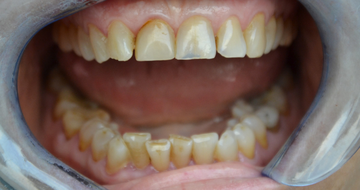 Universal Dark: For natural results in darker teeth