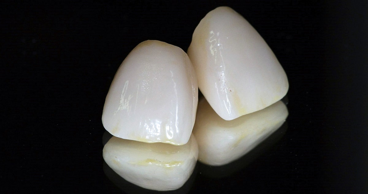 Clinical case – Crowns on 11/21