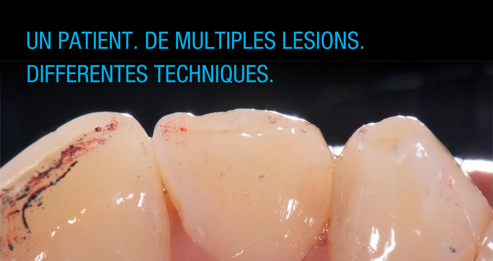 Différentes techniques de restaurations directes sur un même patient