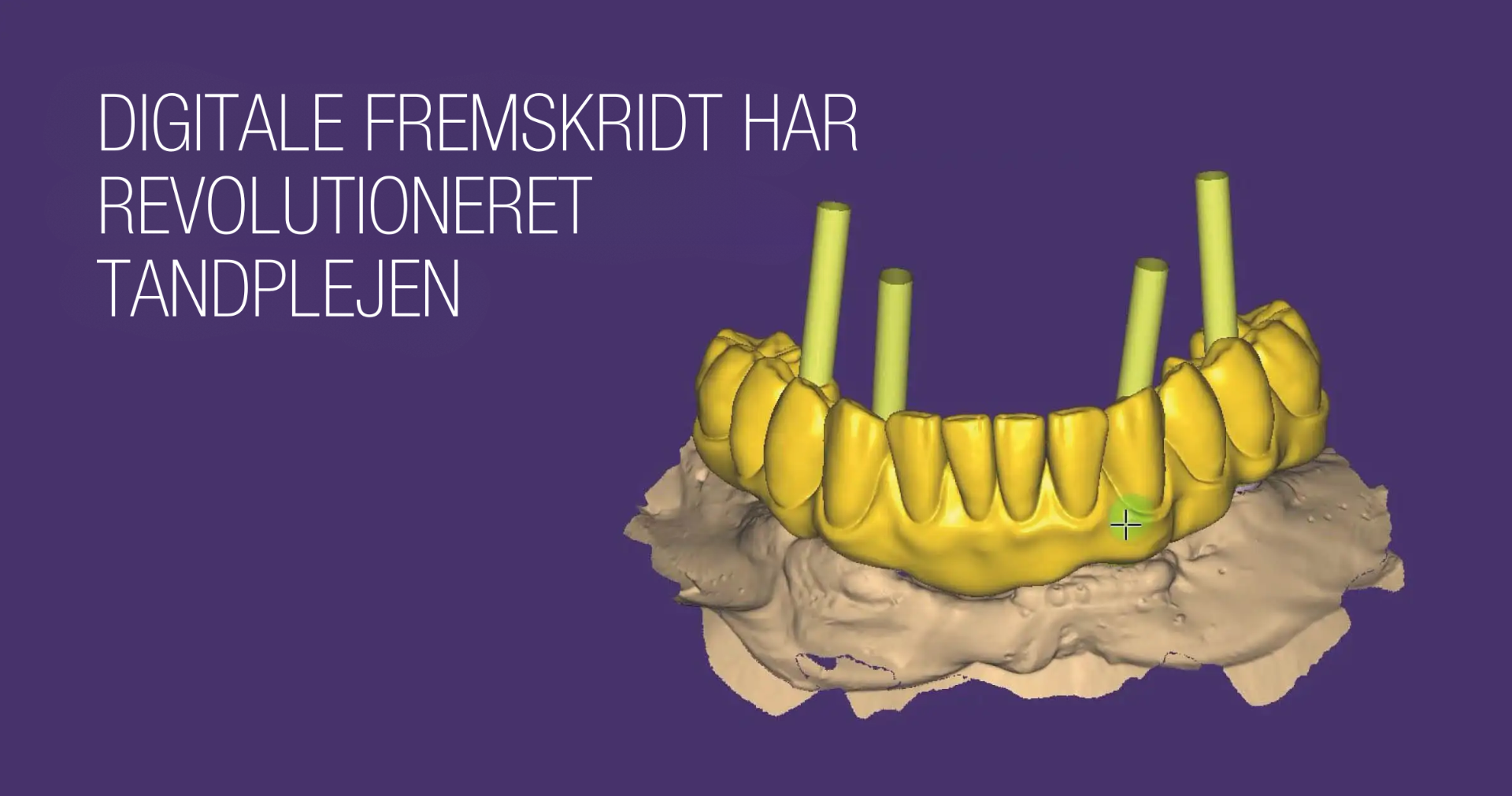Omfattende tandrehabilitering med digitalt workflow
