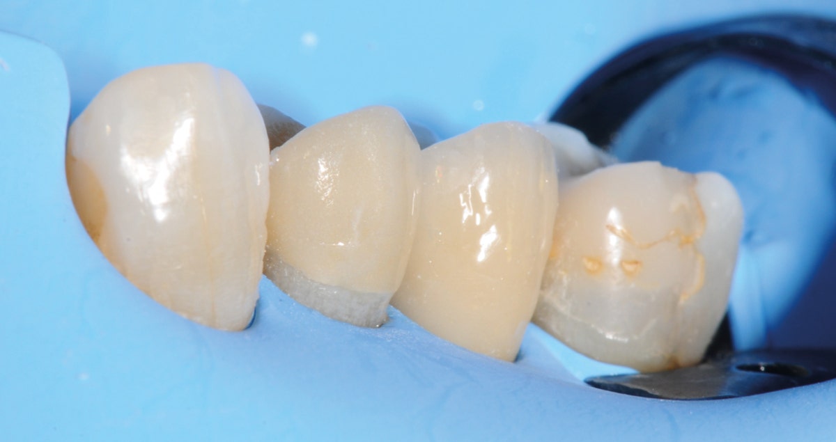 Fractured cusp treatment and amalgam replacement with a lithium disilicate crownlay Fractured cusp treatment and amalgam replacement with a lithium disilicate crownlay