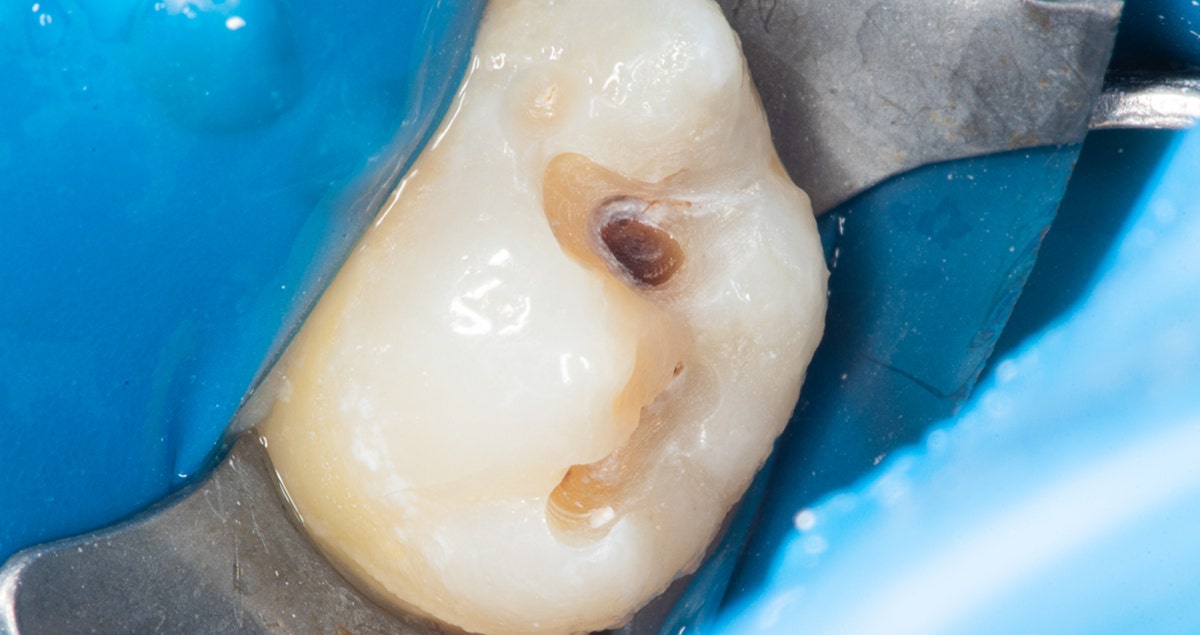 Treatment of primary caries in a third molar