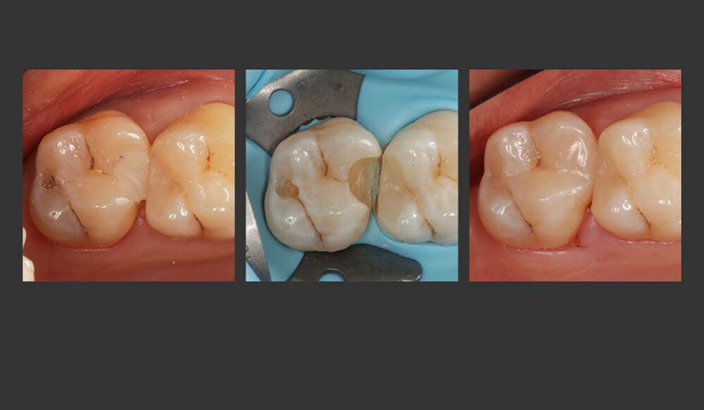CLEARFIL MAJESTY™ ES-2 Universal