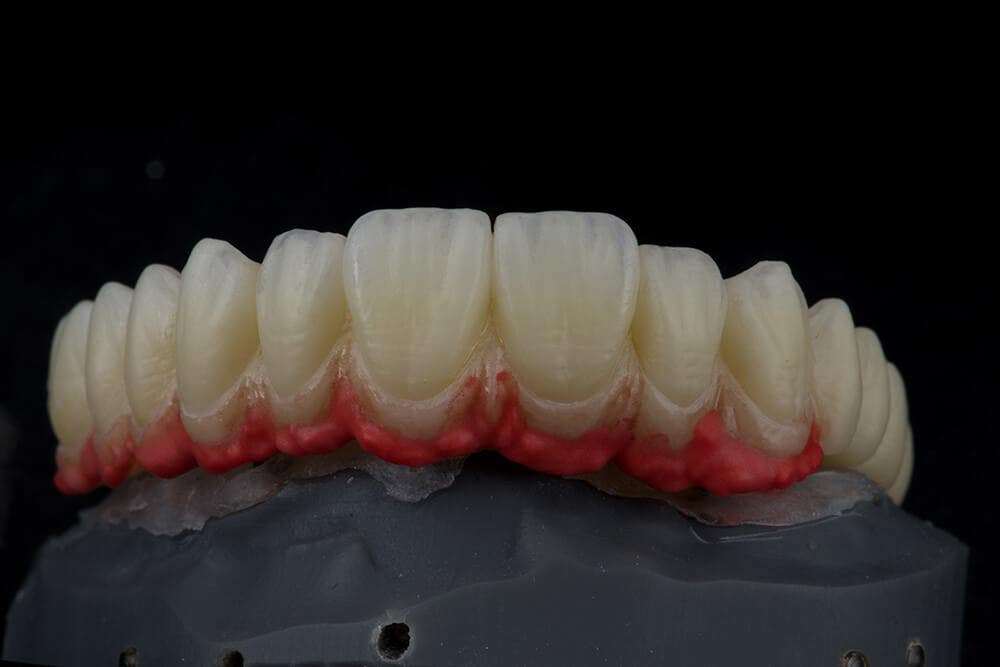 Verblendkeramik-Schichtung der Gingivaanteile