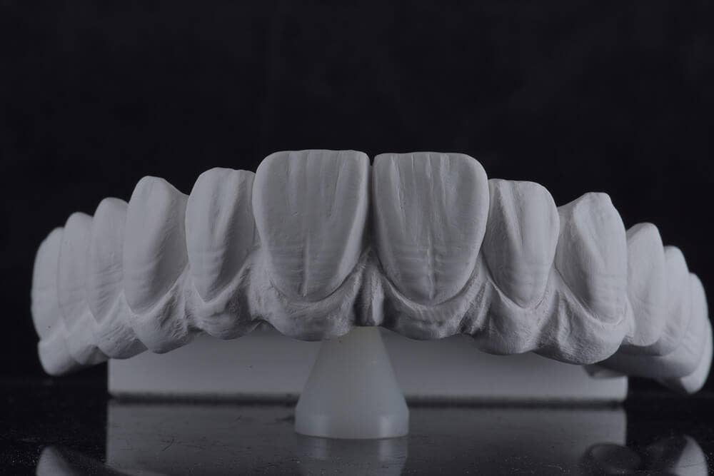 Monolithisch gefrästes Gerüst aus KATANA Zirconia YML