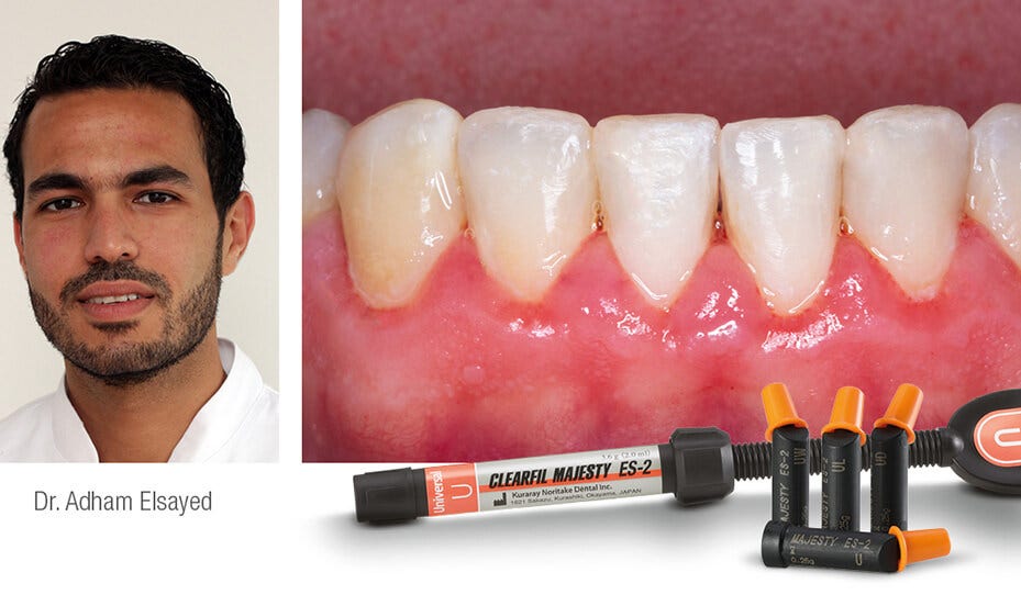 CLEARFIL™ Universal Bond Quick