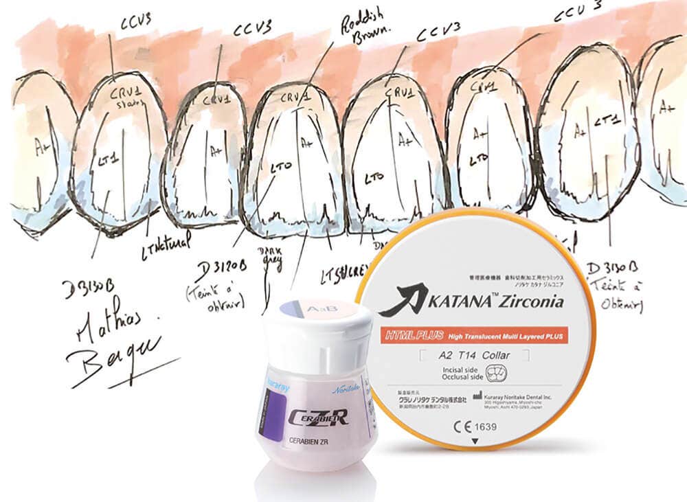 Der effiziente Weg zur Cover-Denture aus Zirkonoxid