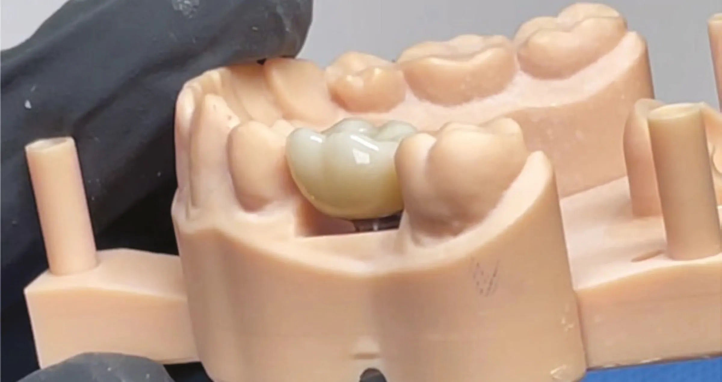 Individuelle Technik für das Verkleben von Abutments 