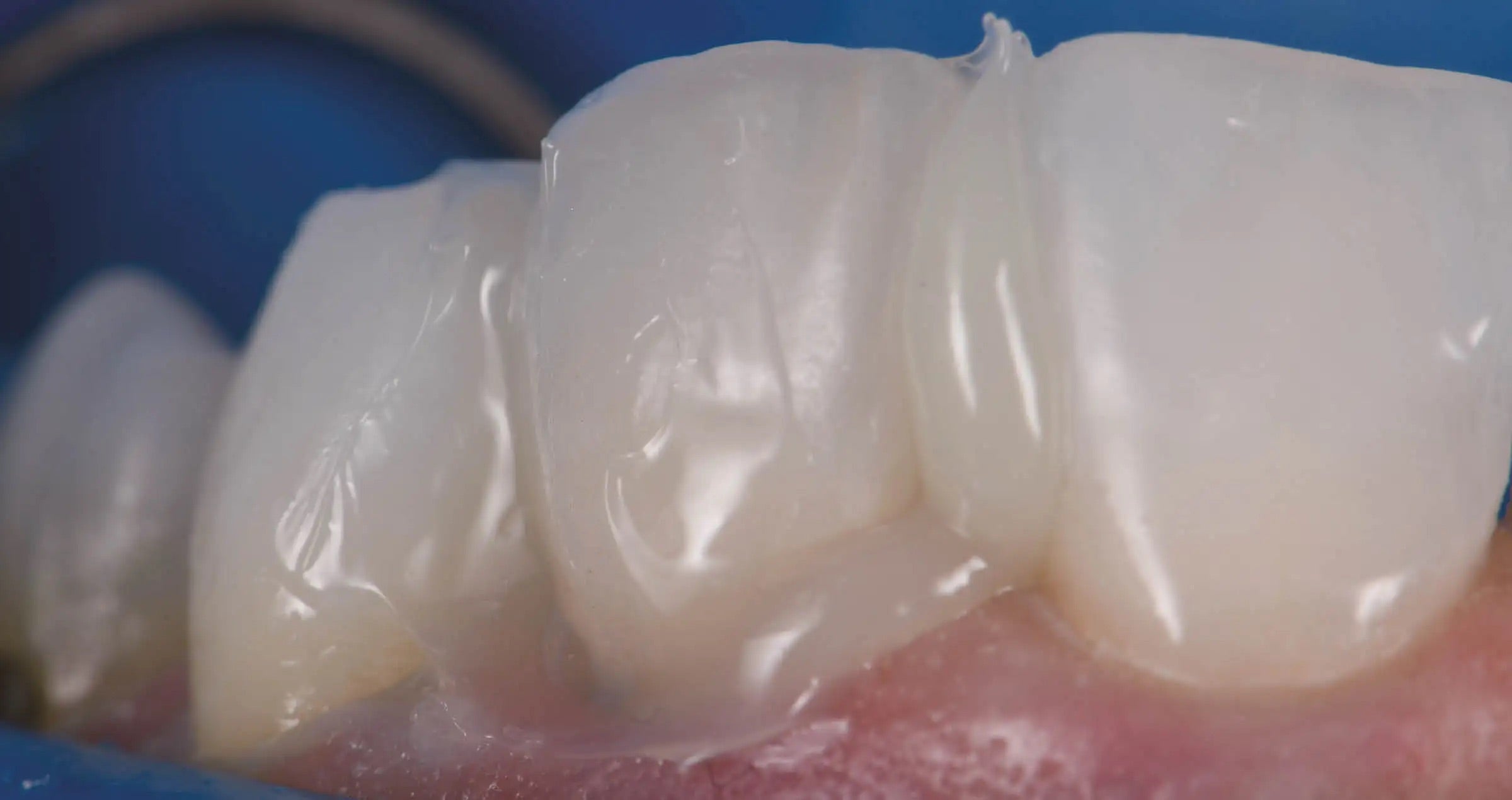 Optimierung der funktionellen und ästhetischen Parameter bei der Befestigung von Veneers