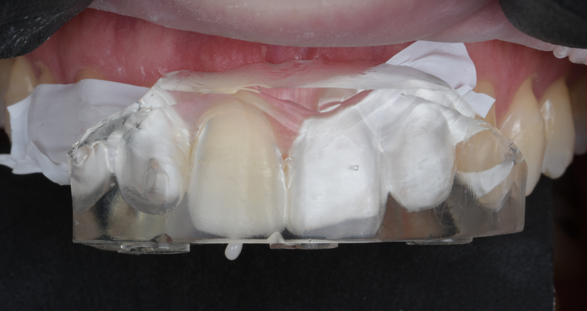 Anwendung des neuen CLEARFIL MAJESTY ES Flow Universal