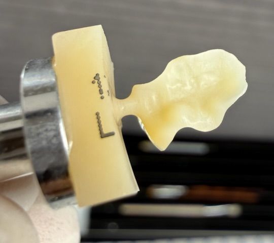CAD/CAM-Kompositrestauration – Ansicht 1