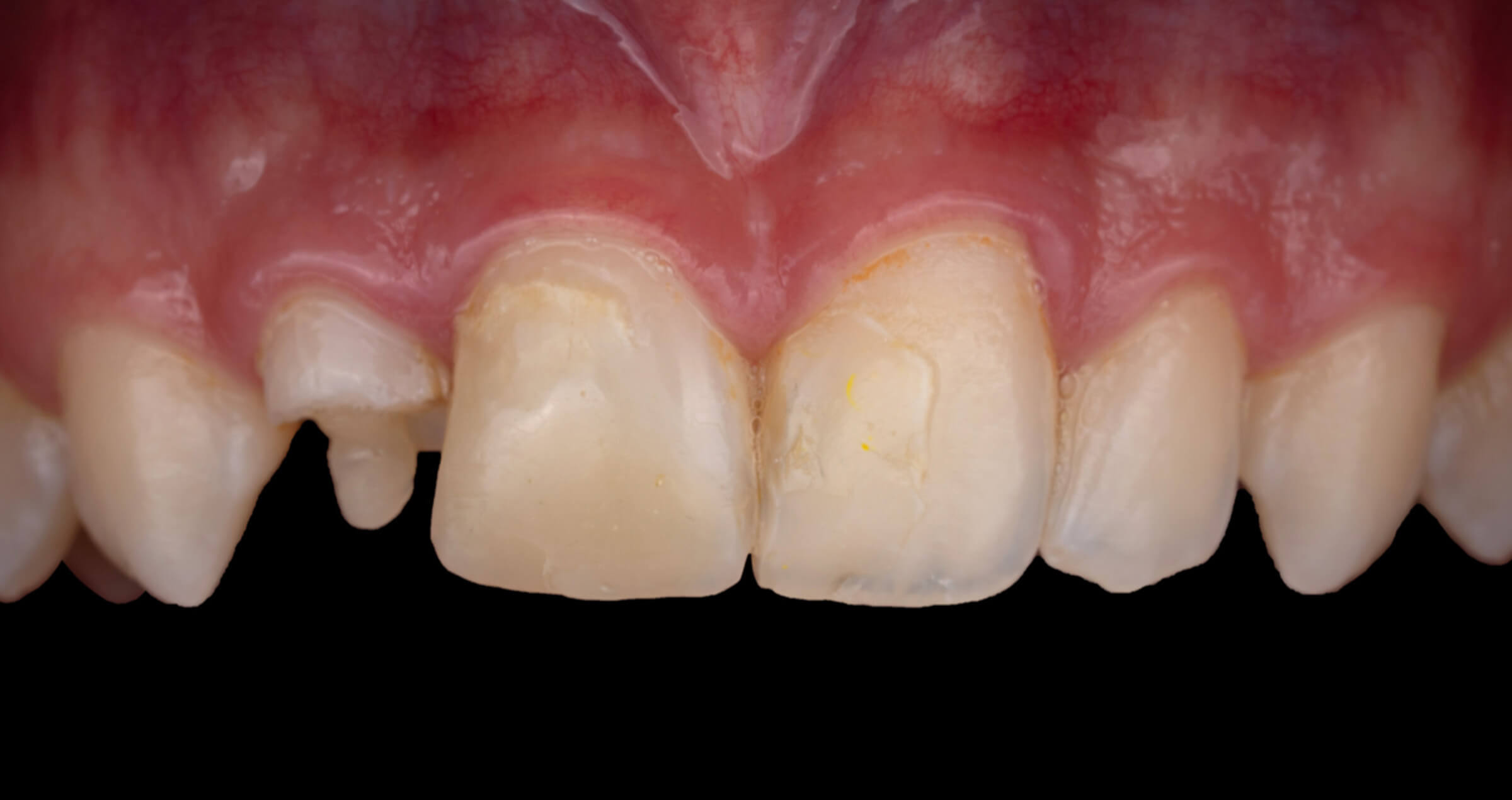Wiederherstellung des Lächelns mit Komposit