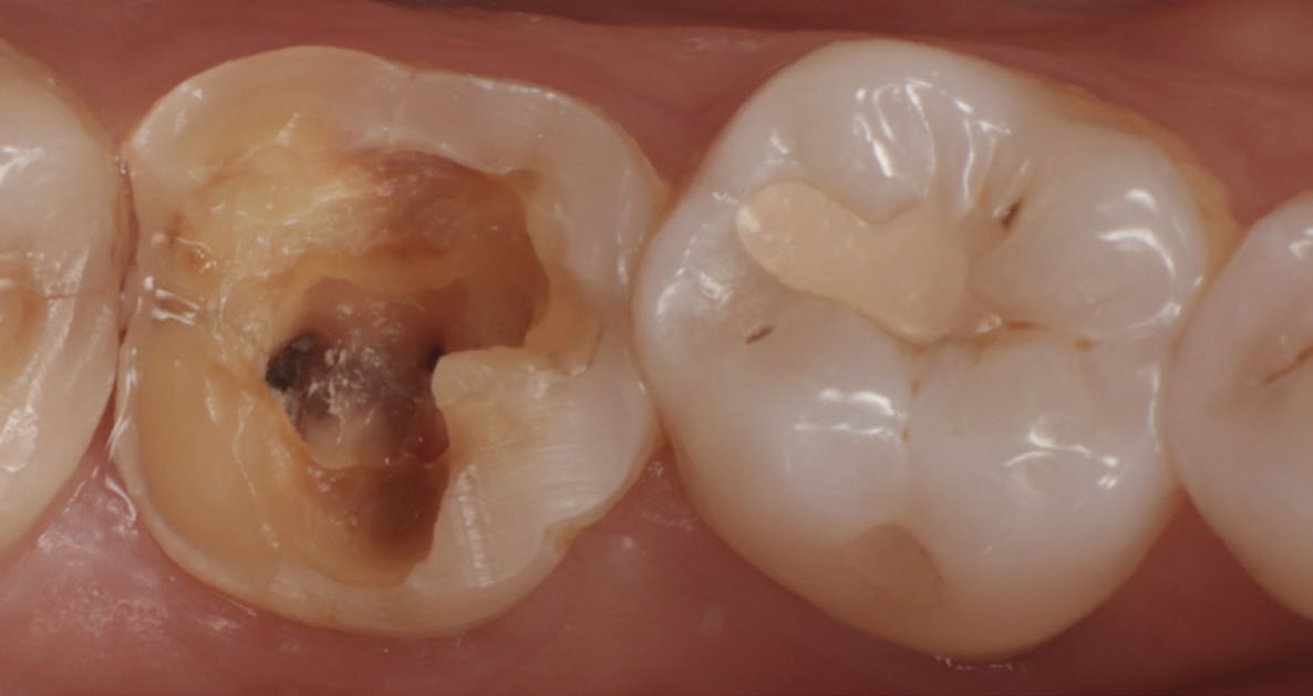 Indirekte Restauration im Seitenzahnbereich mit Katana™ Avencia™ Block 2