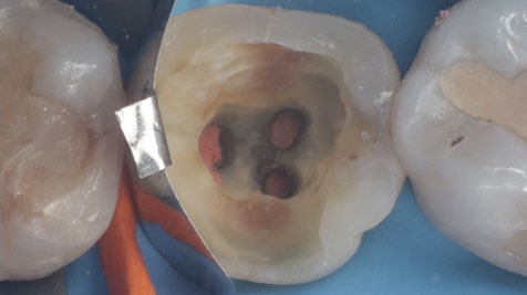 ABB. 2: KLINISCHE UND RÖNTGENOLOGISCHE SITUATION NACH ABSCHLUSS DER ENDODONTISCHEN BEHANDLUNG UND VOR DER REKONSTRUKTION DER VERBLIEBENEN ZAHNHARTSUBSTANZ.