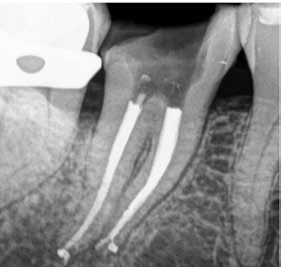 ABB. 2: KLINISCHE UND RÖNTGENOLOGISCHE SITUATION NACH ABSCHLUSS DER ENDODONTISCHEN BEHANDLUNG UND VOR DER REKONSTRUKTION DER VERBLIEBENEN ZAHNHARTSUBSTANZ.