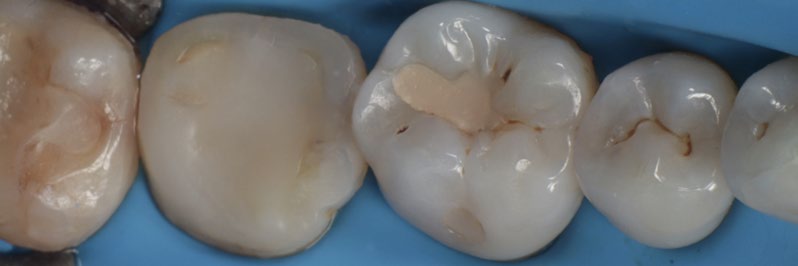 ABB. 3: SOFORTIGER STUMPFAUFBAU MIT CLEARFIL MAJESTY™ ES FLOW UNIVERSAL DARK LOW. DIE REKONSTRUKTION SCHAFFT EINE GLEICHMÄßIGE AUSGANGSBASIS FÜR DIE PRÄPARATION ZUR AUFNAHME DES OVERLAYS.