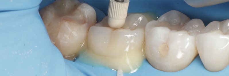 Abb. 10 Definitive adhäsive Befestigung des Overlays mit PANAVIA™ SA Cement Universal Automix in der Farbe Universal (A2). Die präzise Passung der Restauration sowie die kontrollierte Applikation des Befestigungskomposits während des Einsetzens sind gut erkennbar.
