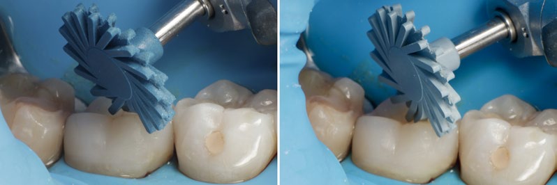 Abb. 13: Endpolitur der Restauration mit dem TWIST™ DIA for Composite