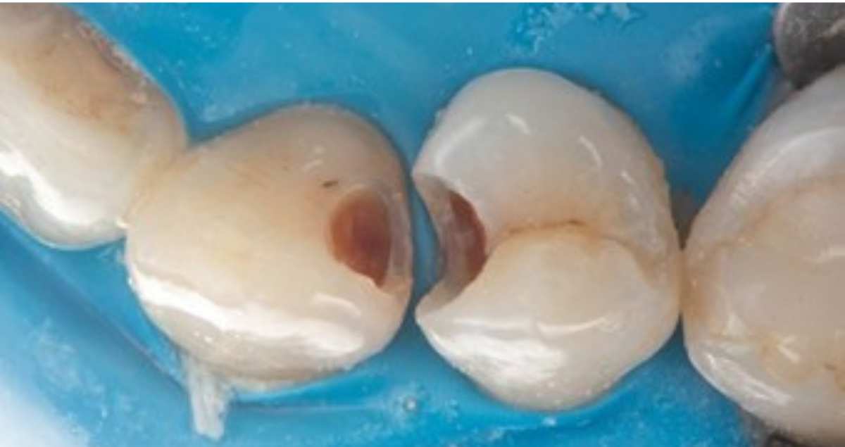 Restaurare directă posterioară conform conceptului Universal Excellence