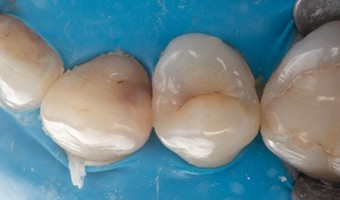 Fig.1: Preoperator – izolarea cu diga dentară