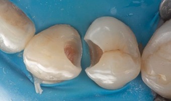 Fig. 3: Cavitățile finisate – margine profundă la premolar