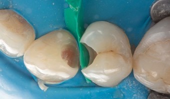 Fig. 4: Pană personalizată aplicată pentru a eleva marginea