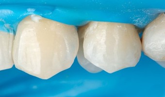 Fig. 5: Vedere vestibulară a dinților după ridicarea marginii profunde cu produse universale