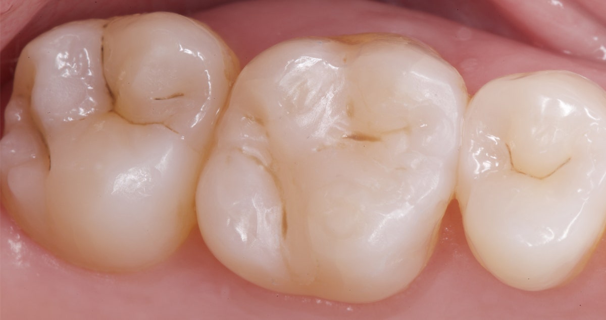 Posterior composite restoration