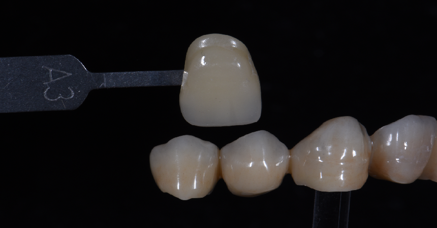 Cas clinique réalisé avec des couronnes postérieurs monolithiques et des couronnes antérieures avec micro-stratification céramique