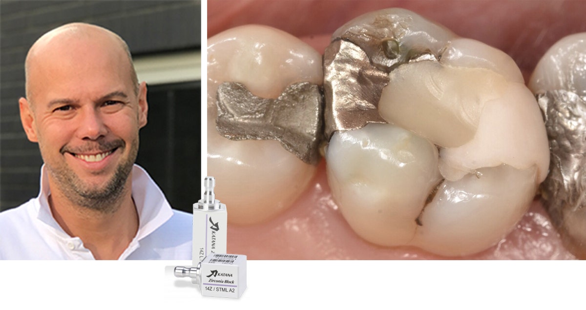Monolithic chairside restorations in the posterior area - effective and efficient