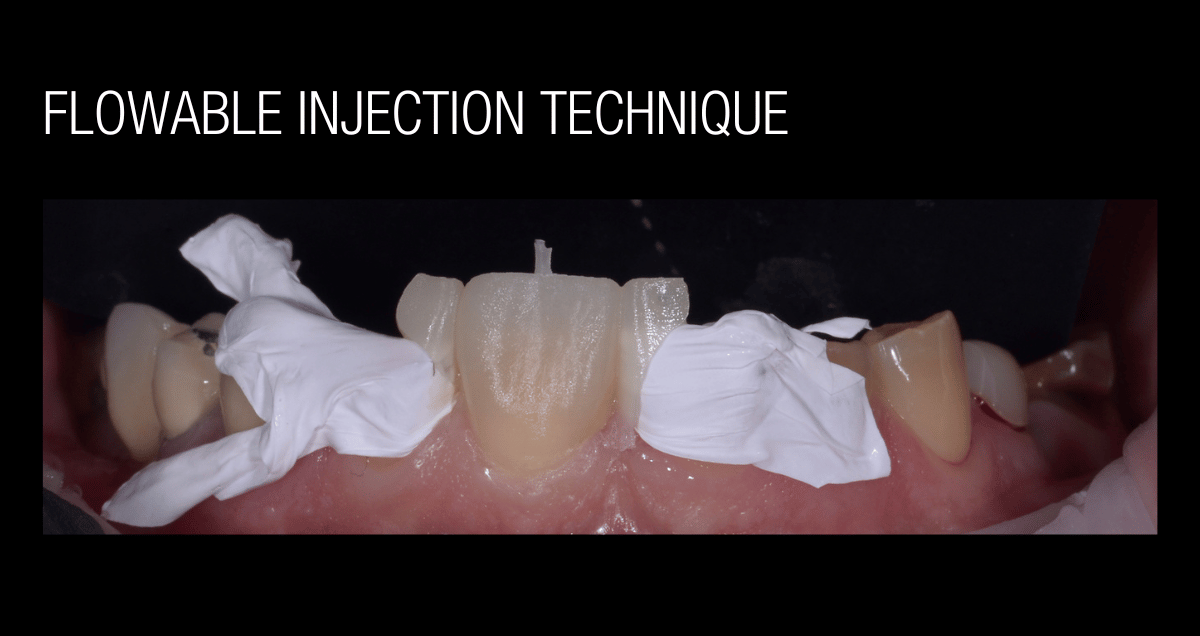 Flowable Injection Technique Preparazione di restauro dentale