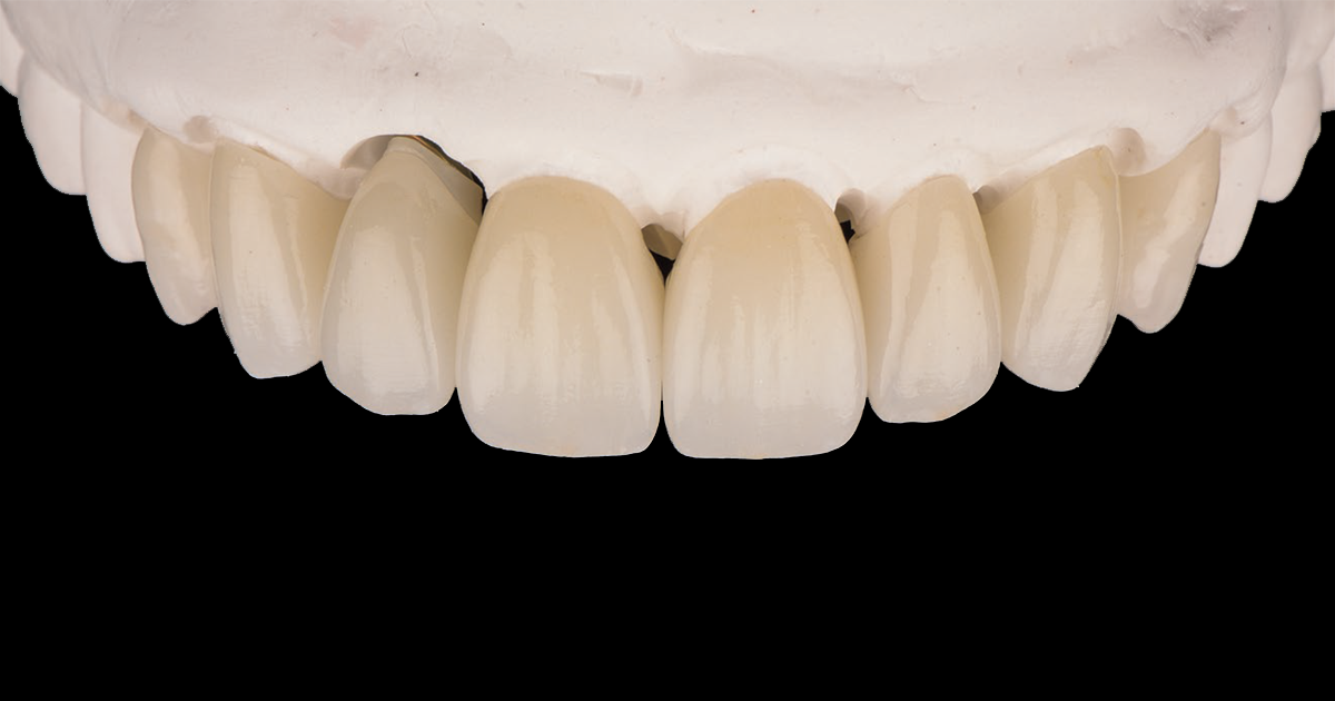 How to cement restorations made of high translucency zirconia