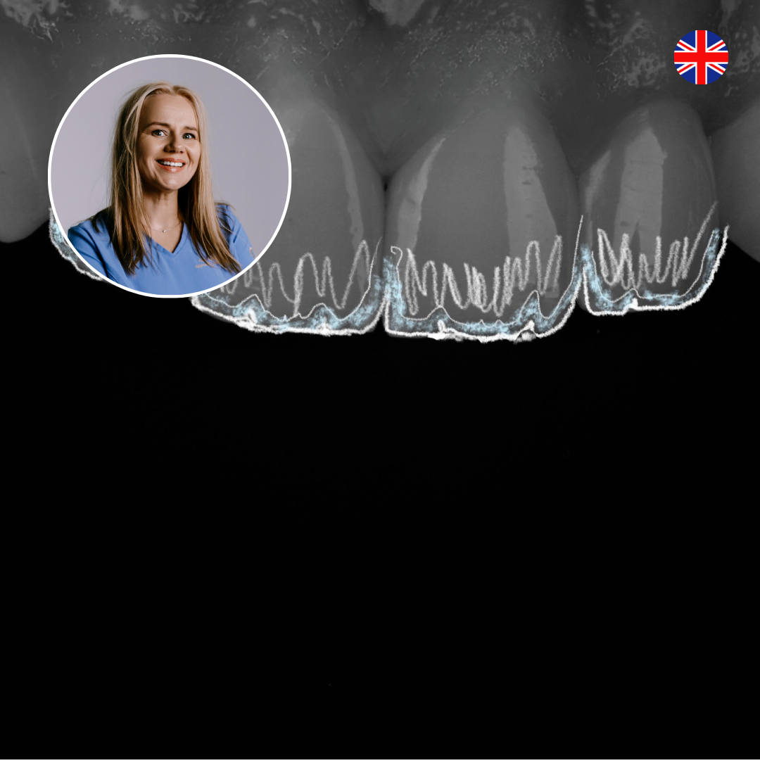 Aesthetic Layering Secrets for Anterior Composites