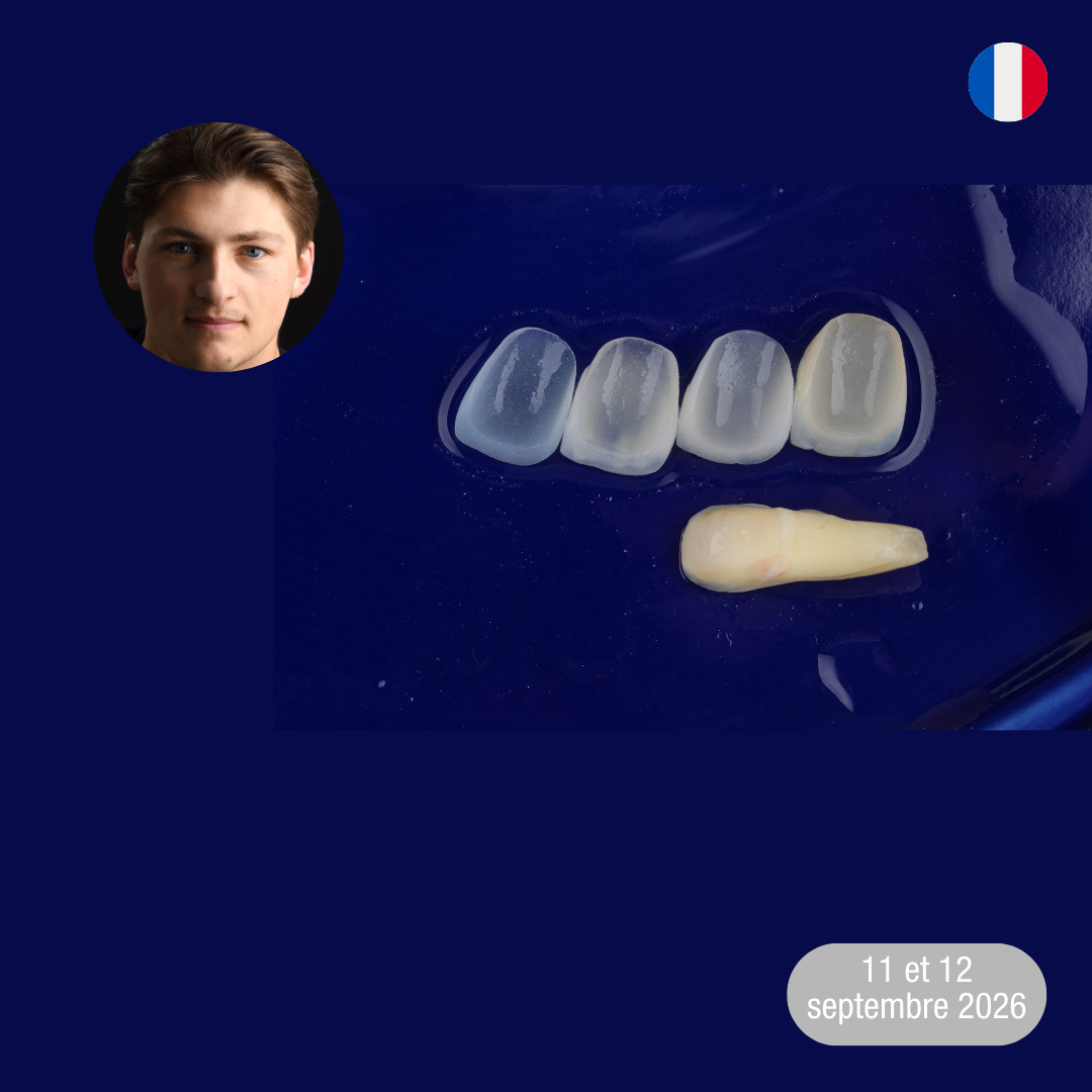 Antérieures : facettes sur dents réfractaires