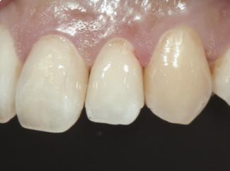 Appliquer et sculpter CLEARFIL MAJESTY™ ES Flow*