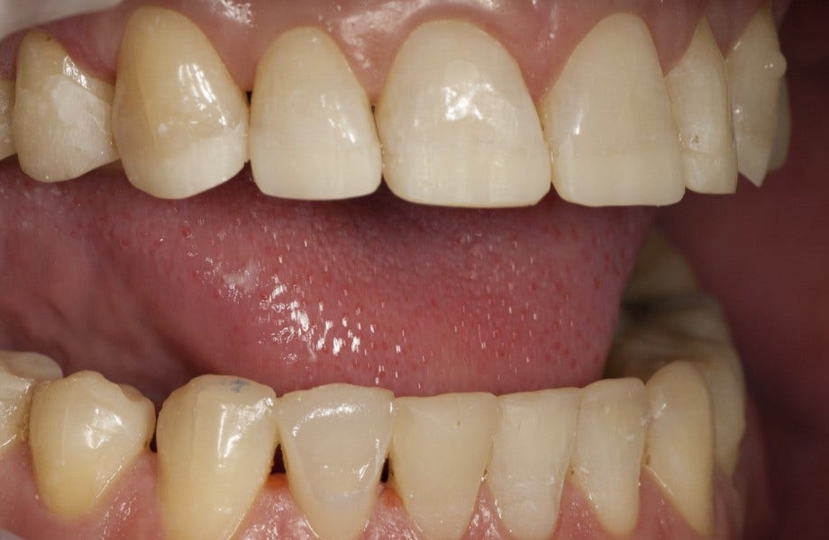 <p><strong>Image 1</strong> Les dents 13 à 23 ont été pourvues de renforts composites palatins ESTENIA™</p>