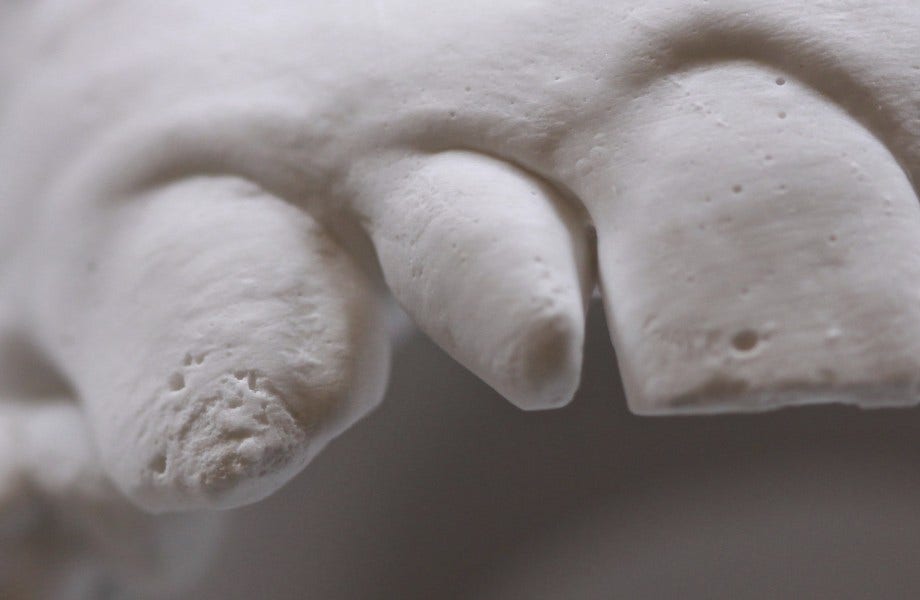 <p><strong>Image 1</strong> Dent naine (12) : restauration à l'aide d'un moule et d'une clé en silicone Teintes appliquées : A3.5D (cervical), A2D et A2E</p>