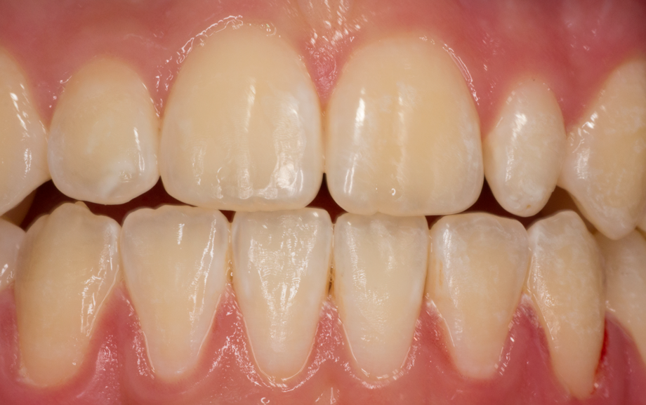 <p><strong>Image 1</strong> Traitement de la dent naine 22 : combinaison de teintes appliquée ; CLEARFIL MAJESTY™ ES-2 PREMIUM A2D et A2E</p>
