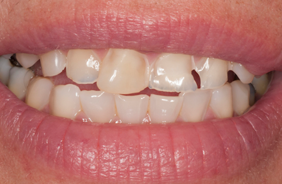 <p><strong>Image 1</strong> Patient avec érosion sévère: les dents ont été restaurées et plaquées avec la combinaison de teintes A2D et A2E, CLEARFIL MAJESTY ™ ES-2 PREMIUM </p>