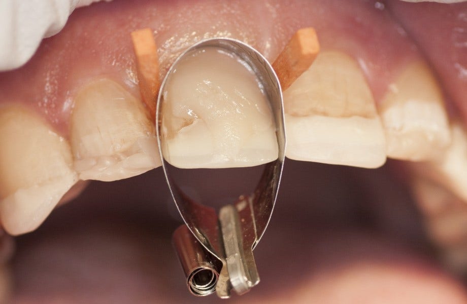 <p><strong>Image 2 </strong>Une première couche de CLEARFIL MAJESTY™ ES-2 PREMIUM A3D composite a été appliquée. La transition est maintenant à peine perceptible.</p>