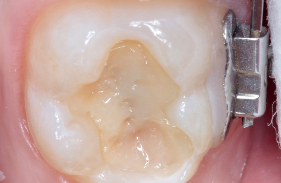 <p><strong>Image 3.</strong> A2D utilisé en remplacement de la dentine</p>